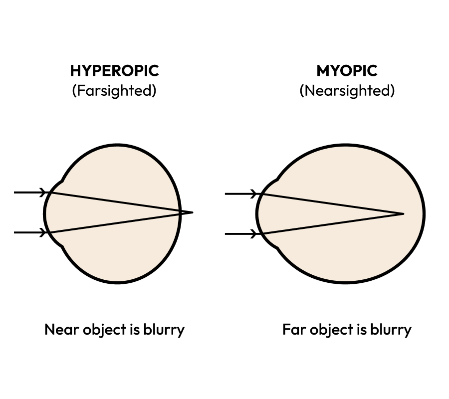 An image showing the cause of nearsightedness and farsightedness