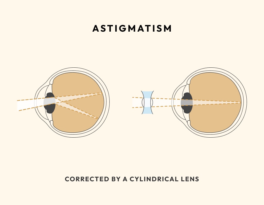 An image showing how astigmatism works in the eye