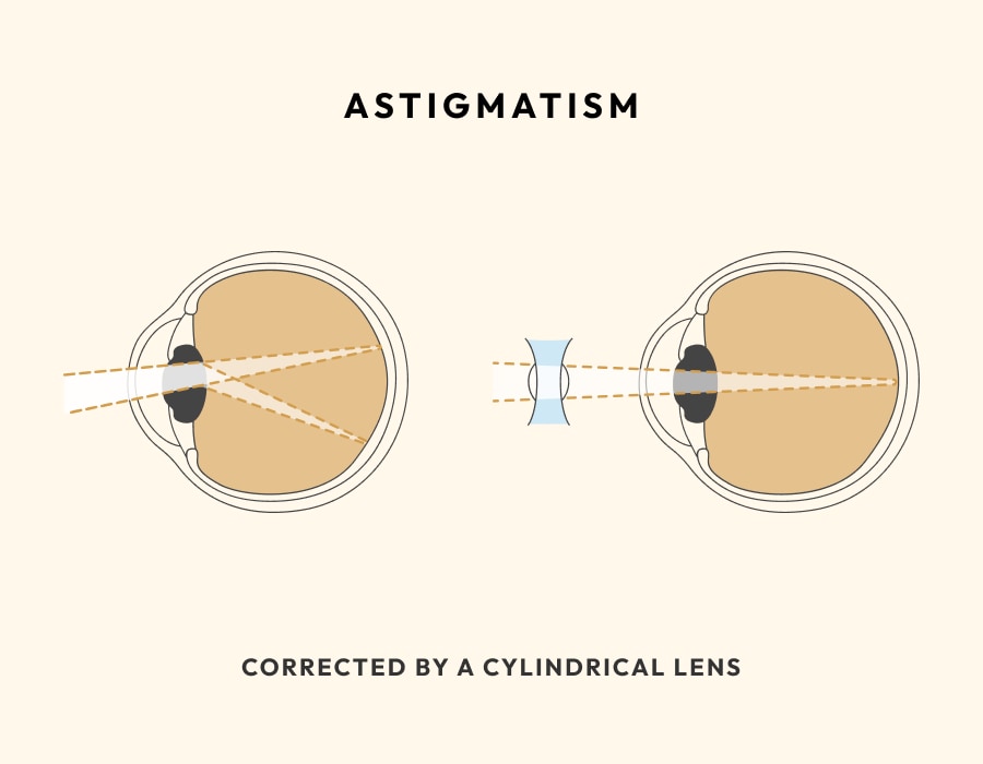 person with astigmatism