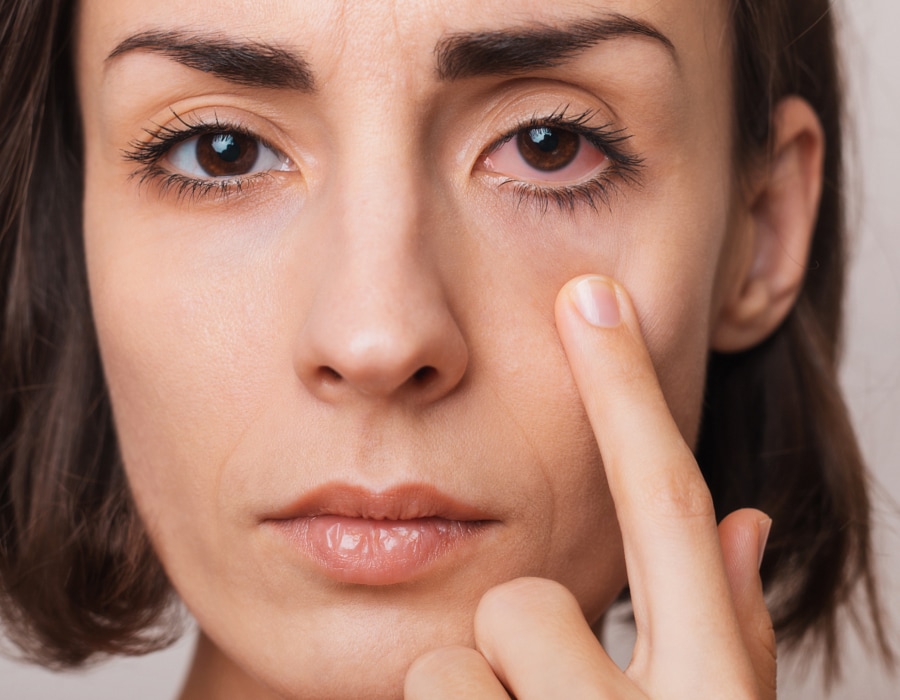 A closeup of a woman pointing to her left eye which is red and inflamed