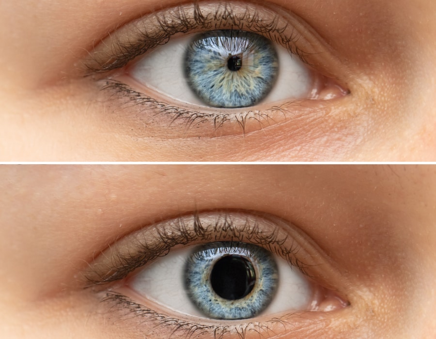 A split showing showing a blue eye with a small pupil on the top and one with a large pupil on the bottom