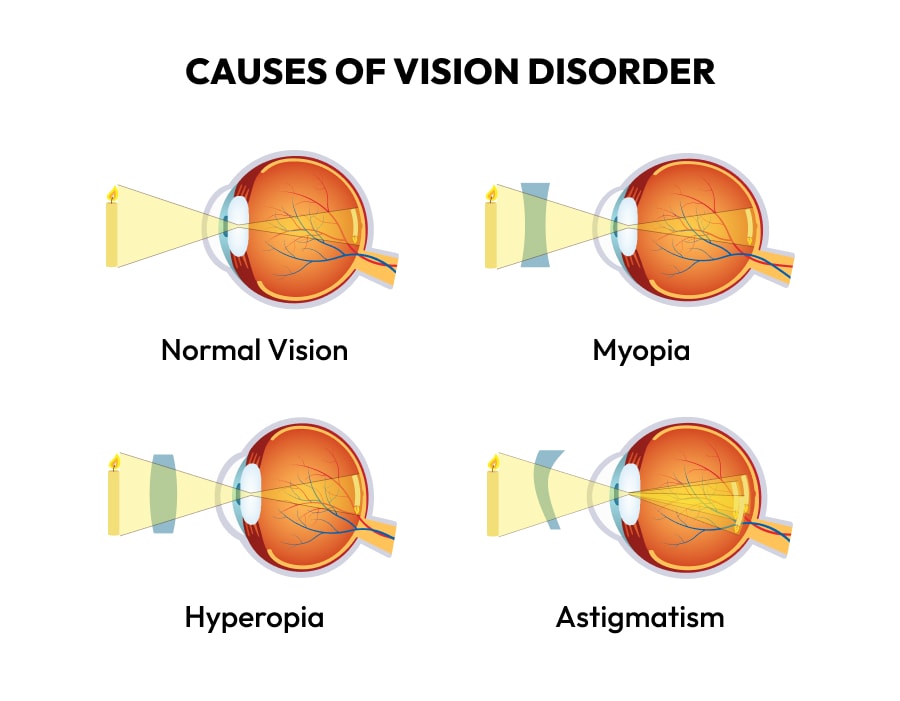 An infographic showing some causes of vision disorders