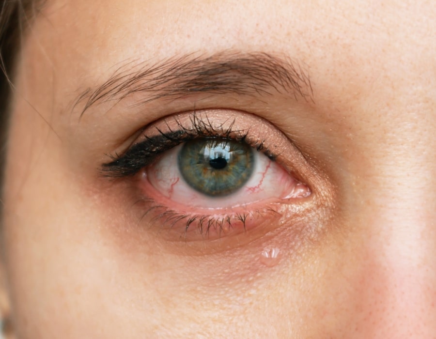 A closeup image of an inflamed eye