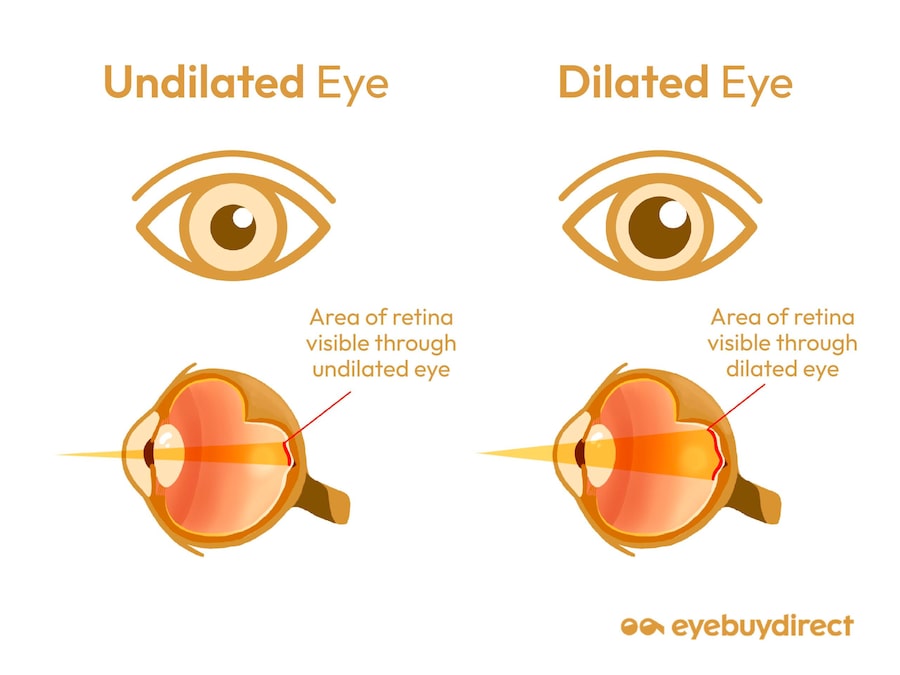 An infographic showing examples of dilated and non-dilated pupils