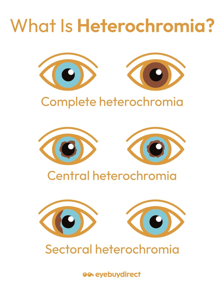 An infographic showing examples of three different types of heterochromia