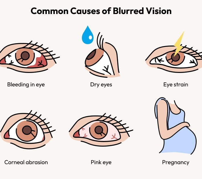 An infographic showing different causes of blurred vision